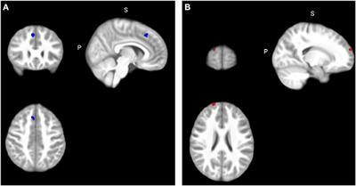 Motor Abnormalities in Attention-Deficit/Hyperactivity Disorder and Autism Spectrum Disorder Are Associated With Regional Grey Matter Volumes